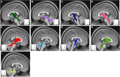 White Matter Tract Alterations in Drug-Naïve Parkinson’s Disease Patients With Impulse Control Disorders